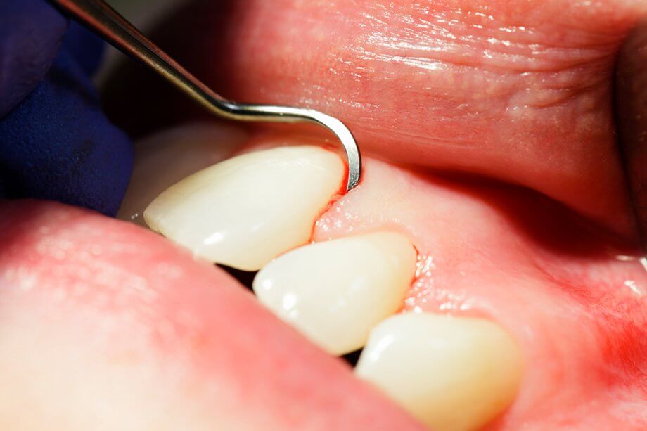 When Bleeding Gums Signal a Serious Dental Problem